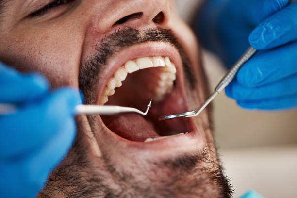 Best Emergency Wisdom Teeth Removal in Wimberley, TX